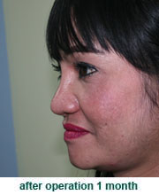 plastic_surgery_augmentation_rhinoplasty